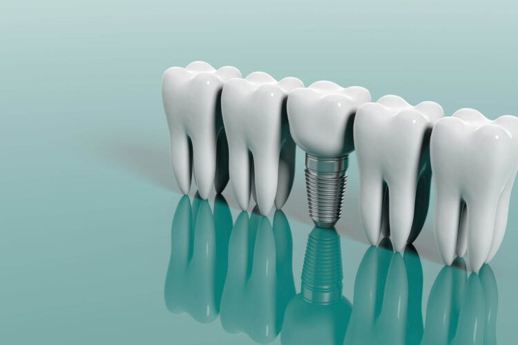 When should dental implants be considered - Nu Cuoi Duyen Dental Clinic