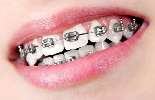 Can braces be worn at the age of 15? What is the best age for orthodontic treatment?