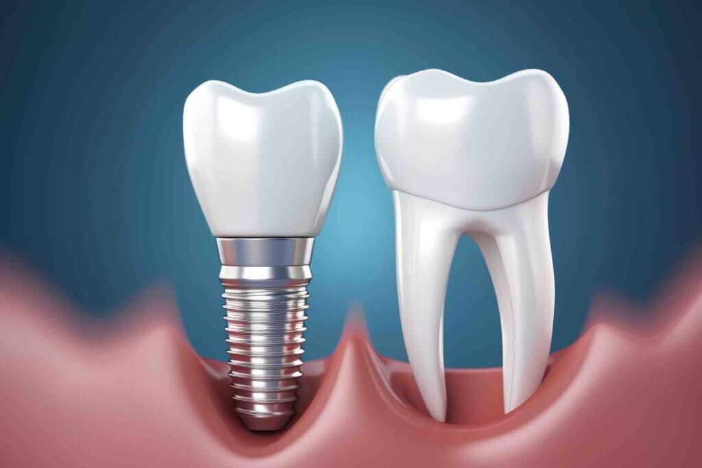 Dịch vụ cắm ghép Implant - Nha khoa Nụ Cười Duyên