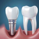 Dịch vụ cắm ghép Implant - Nha khoa Nụ Cười Duyên