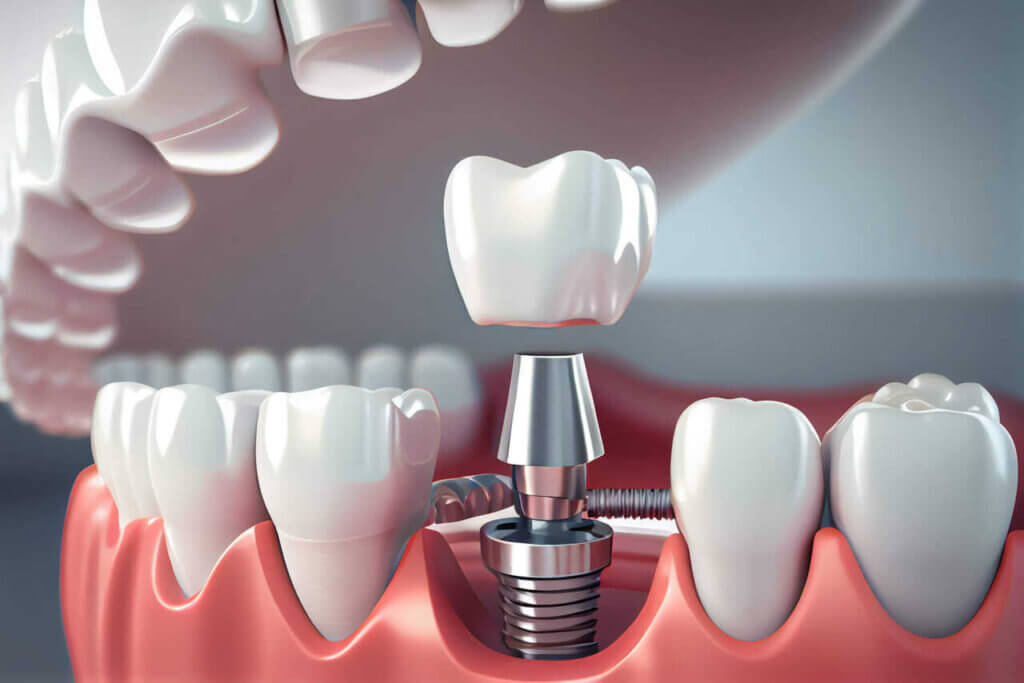 Địa điểm trồng implant chuyên nghiệp tại Bình Dương