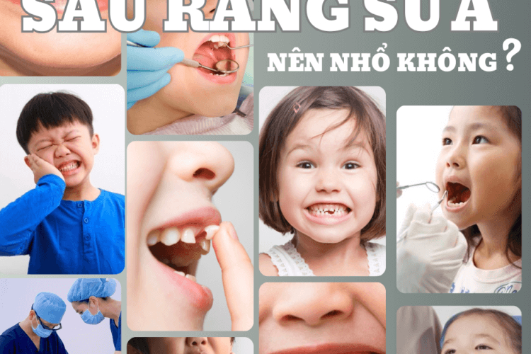 Sâu răng sữa có nên nhổ không?