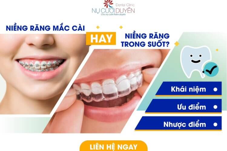 Niềng răng mắc cài hay niềng răng trong suốt Invisalign