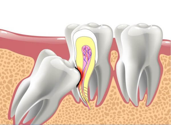 Răng khôn mọc lệch - Nha khoa Nụ Cười Duyên