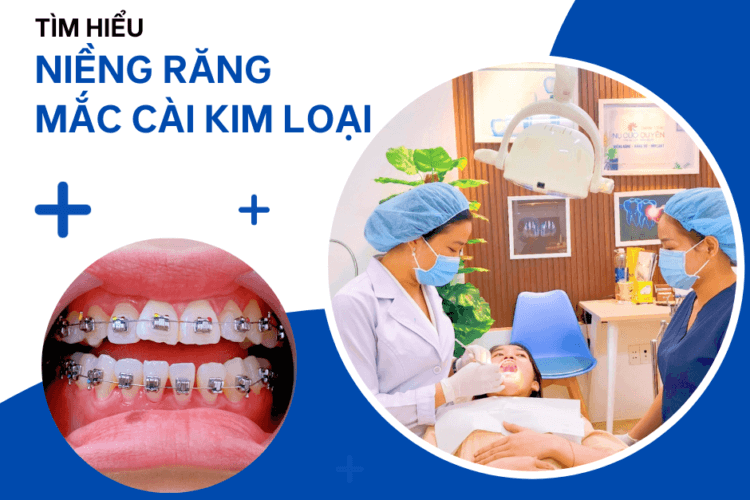 niềng răng mắc cài kim loại