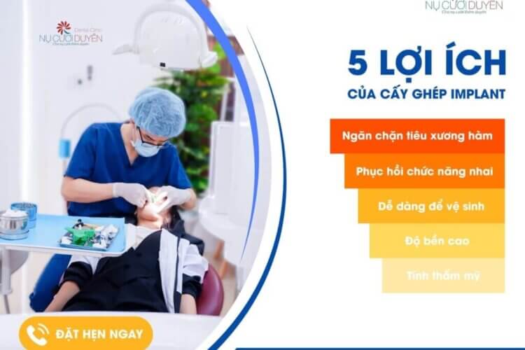 5 lợi ích cắm ghép implant