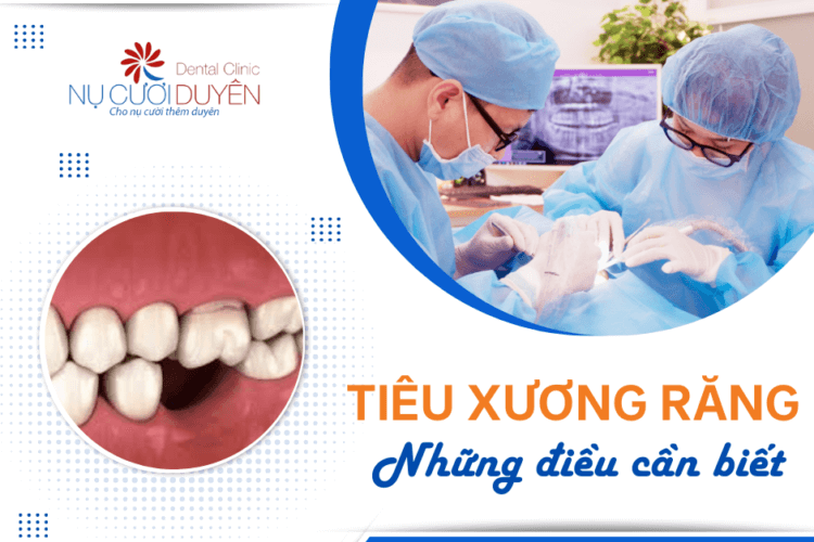 Tiêu xương răng: Những điều cần biết