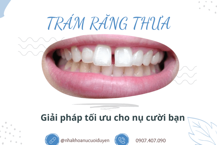 Trám răng thưa - Giải pháp tối ưu cho nụ cười bạn