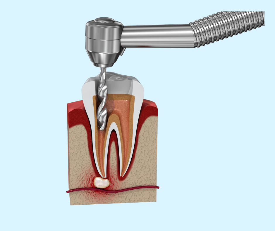 Tại sao phải lấy tủy răng?