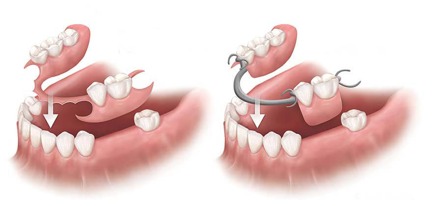 So sánh răng giả tháo lắp và răng implant - Nha khoa Nụ Cười Duyên Bình Dương