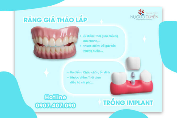 Nên chọn trồng răng Implant hay Răng giả tháo lắp - Nha khoa Nụ Cười Duyên