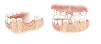 Tiêu xương răng: Những điều cần biết